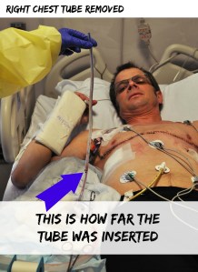 Chest tube removed DSC_0120B