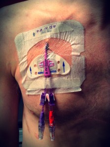 Hickman catheter IMG_0125