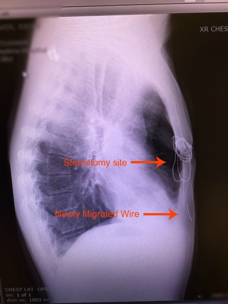 CXR Side view
